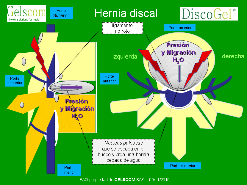 Formacion de la hernia discal
