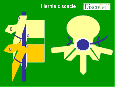 hernie discacle